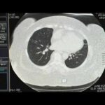Study links severe COVID or flu to higher lung cancer risk