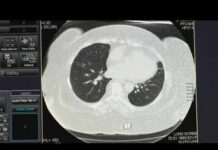 Severe Virus Secretly Triggers Cancer Risk Study links severe COVID or flu to higher lung cancer risk