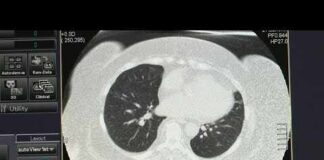 Study links severe COVID or flu to higher lung cancer risk