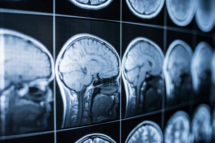 shutterstock_1113389069.jpg Close-up of MRI brain scans displayed on a screen