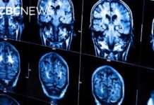 Canada’s Bold New Medical Move Shocks the U.S. New guidelines urge doctors to treat heart and brain health