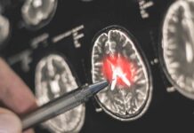 A hand pointing at a brain scan with highlighted areas