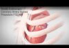 Totally Endoscopic Coronary Artery Bypass Procedure (TECAB)