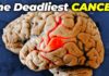 Why Brain Cancer is SO Dangerous