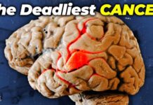 Why Brain Cancer is SO Dangerous Why Brain Cancer is SO Dangerous