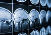 Daily Sweat, Younger Brain Scans Close-up of MRI brain scans displayed on a screen