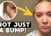 Silent Painless Lumps, High-Stakes Clock Diagnosed With Leiomyosarcoma: The RARE CANCER Symptom I Couldn't Ignore
