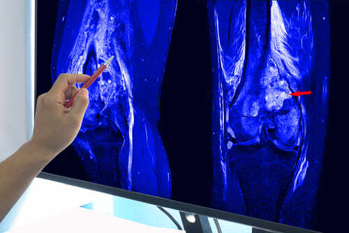 Magnetic,Resonance,Imaging,(mri),Of,Right,Knee,Suggestive,Of,Malignant A hand pointing at an MRI scan of a knee joint on a monitor