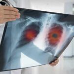 Women’s Lung Cancer Surge—Not From Smoking? Doctor holding chest X-ray with highlighted lung areas