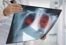 Doctor holding chest X-ray with highlighted lung areas