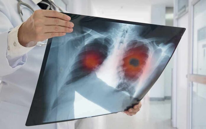 Doctor holding chest X-ray with highlighted lung areas