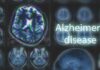 Harvard’s Lithium Twist Shocks Alzheimer’s Playbook Brain MRI scans with highlighted section and text overlay