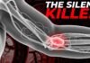 The Silent Warning Signs of Blood Clots