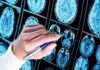 Hidden Immune Organ Found in Skull Hand with pen pointing at brain MRI scans
