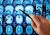 Mystery Aneurysm Surge Alarms Philadelphia Hand pointing at brain MRI scans with a pen