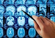 Mystery Aneurysm Surge Alarms Philadelphia Hand pointing at brain MRI scans with a pen